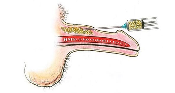 Azido hialuronikoaren injekzioak kide baten upelean, handitzeko asmoz